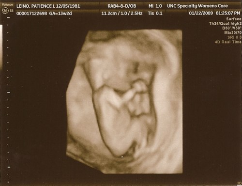 3D Ultrasound 13wks